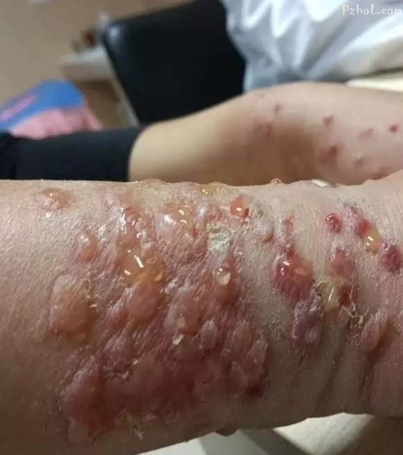 然而这不是最可怕的,由于这些虫子身体小 还喜欢温暖的地方,有人的